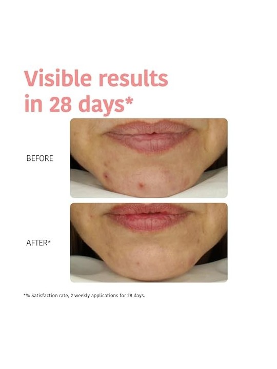 Iroha PERFECT SKIN PEELING acido glicolico e centella asiatica