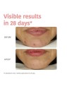 Iroha PERFECT SKIN PEELING acido glicolico e centella asiatica
