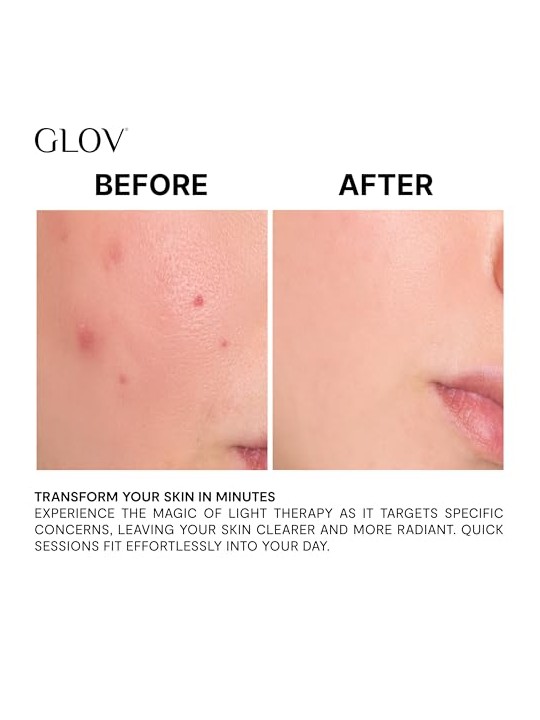 Glov Trattamento antiacne Supernova con LED