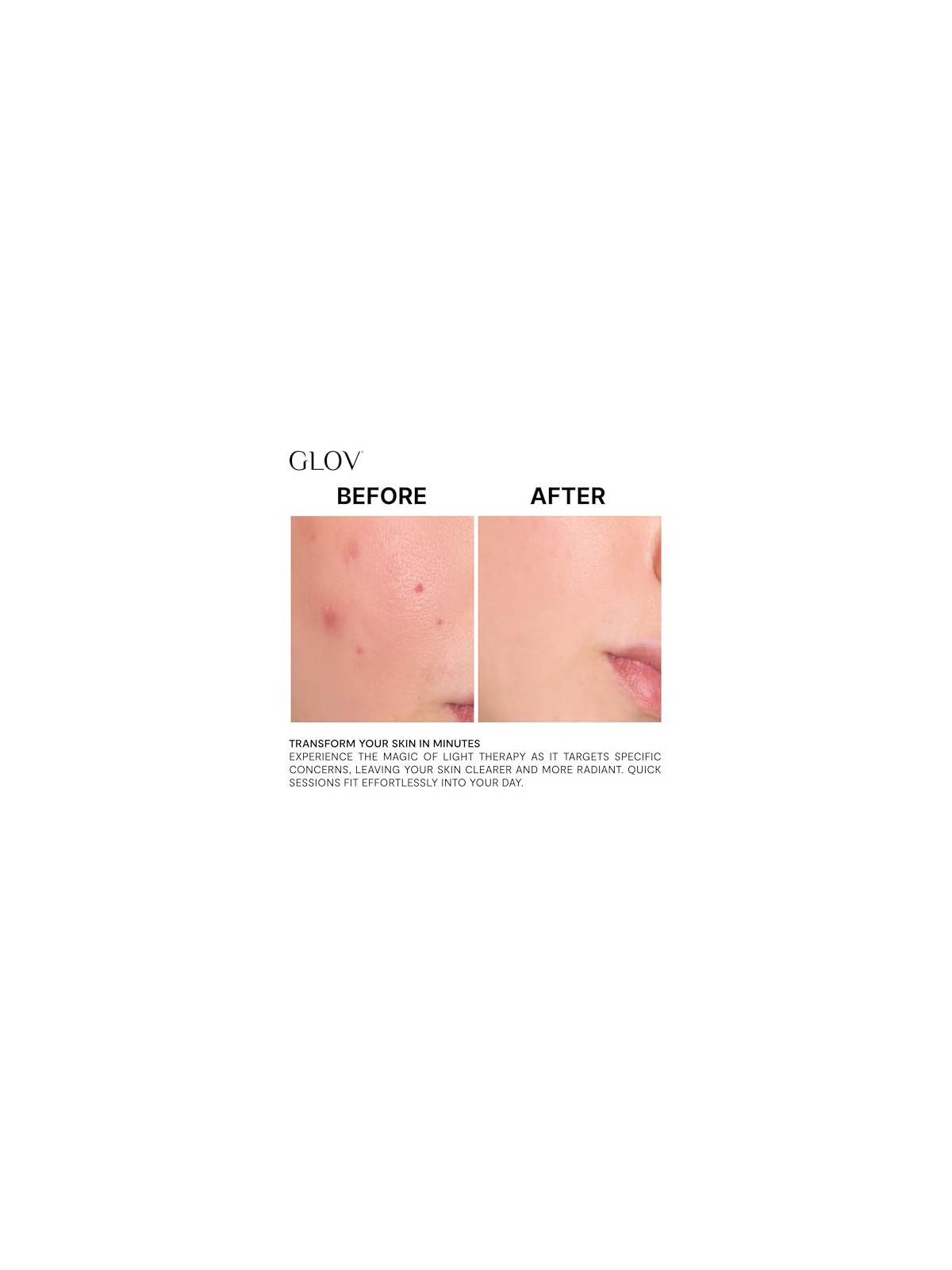 Glov Trattamento antiacne Supernova con LED
