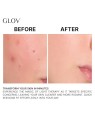 Glov Trattamento antiacne Supernova con LED